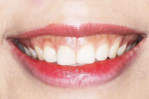 笑露牙龈 面相_笑露牙齿的女人面相_牙齿缝隙大的女人面相