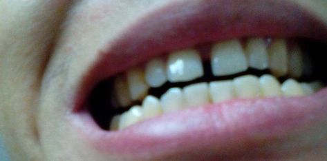 牙齿稀疏的女人面相_眉毛尾部稀疏女人面相_牙齿不整齐的女人面相